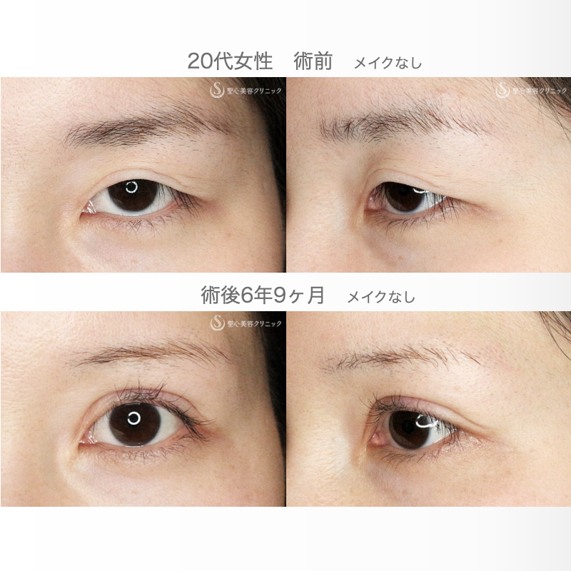 【20代女性・他院で2回眼瞼下垂術後の修正】二重全切開+α法「Ver.3」（6年8ヶ月後） After 