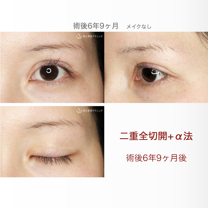 【20代女性・他院で2回眼瞼下垂術後の修正】二重全切開+α法「Ver.3」（6年8ヶ月後） After 