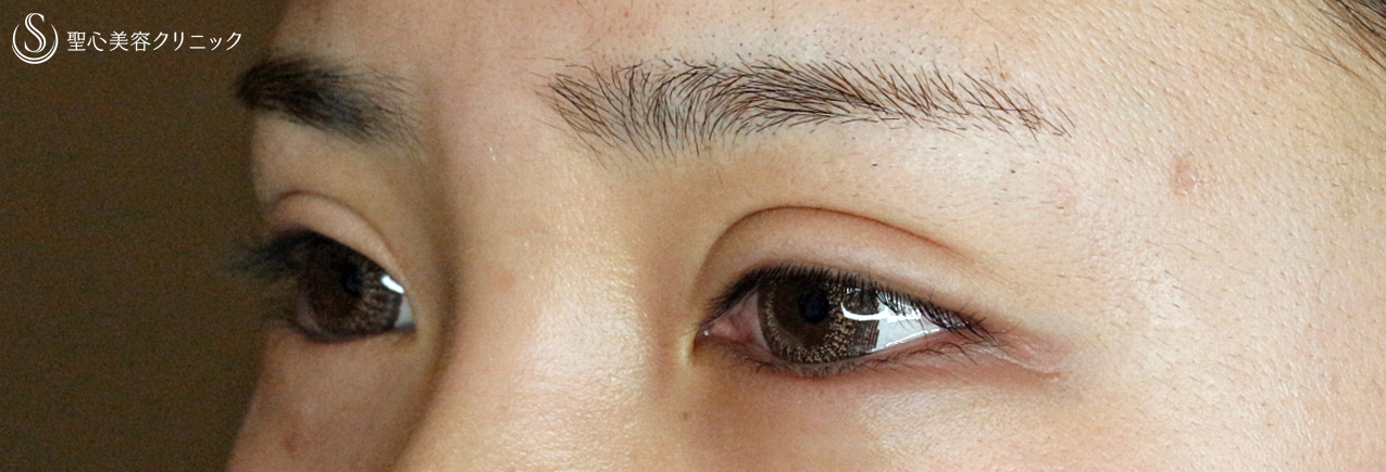 【20代女性・他院修正ハム目から美しい目元へ】二重全切開+α法（6年後）目尻切開＆グラマラスライン（3年後）眉下リフト（1年後） Before 