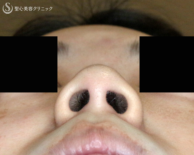 【20代女性・鼻翼縮小術の長期経過】小鼻縮小術+α法（5年半後） After 