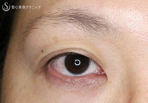 【30代女性・術中に凍りついた他院修正（長期経過）】二重全切開+α法「Ver.3」（8年後） Before 