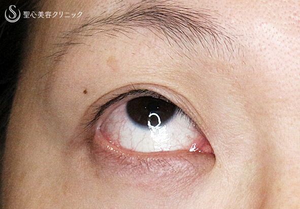 【30代女性・術中に凍りついた他院修正（長期経過）】二重全切開+α法「Ver.3」（8年後） Before 