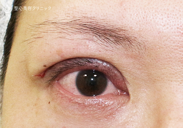 【30代女性・術中に凍りついた他院修正（長期経過）】二重全切開+α法「Ver.3」（8年後） Before 