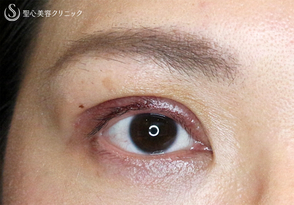 【30代女性・術中に凍りついた他院修正（長期経過）】二重全切開+α法「Ver.3」（8年後） Before 