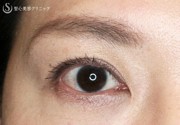 【30代女性・術中に凍りついた他院修正（長期経過）】二重全切開+α法「Ver.3」（8年後） Before 