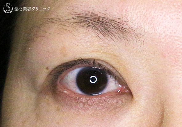 【30代女性・術中に凍りついた他院修正（長期経過）】二重全切開+α法「Ver.3」（8年後） After 
