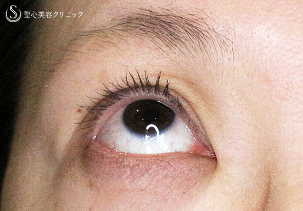 【30代女性・術中に凍りついた他院修正（長期経過）】二重全切開+α法「Ver.3」（8年後） After 