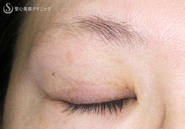 【30代女性・術中に凍りついた他院修正（長期経過）】二重全切開+α法「Ver.3」（8年後） After 