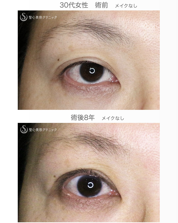 【30代女性・術中に凍りついた他院修正（長期経過）】二重全切開+α法「Ver.3」（8年後） After 