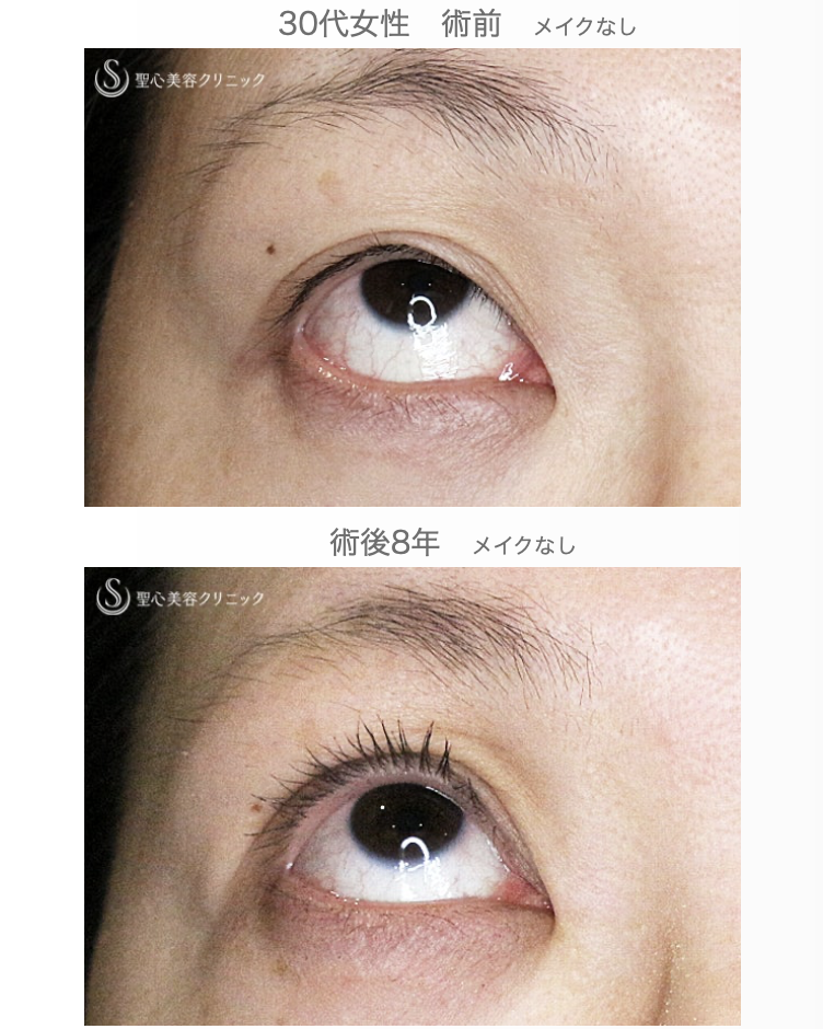 【30代女性・術中に凍りついた他院修正（長期経過）】二重全切開+α法「Ver.3」（8年後） After 