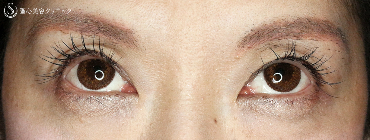 【40代女性・目が重く左右差あり】切らない眼瞼下垂+α法（2年後） After 