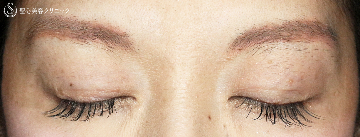 【40代女性・目が重く左右差あり】切らない眼瞼下垂+α法（2年後） After 