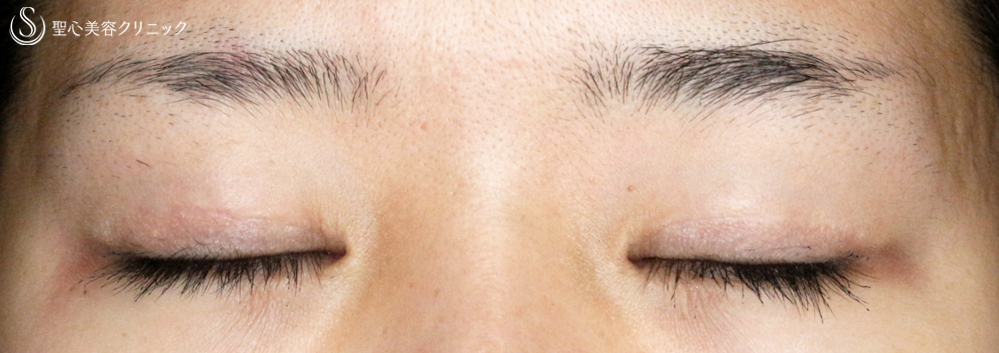 【20代女性・華やかな目元へ】目頭切開＆二重全切開+α法（5年後） After 