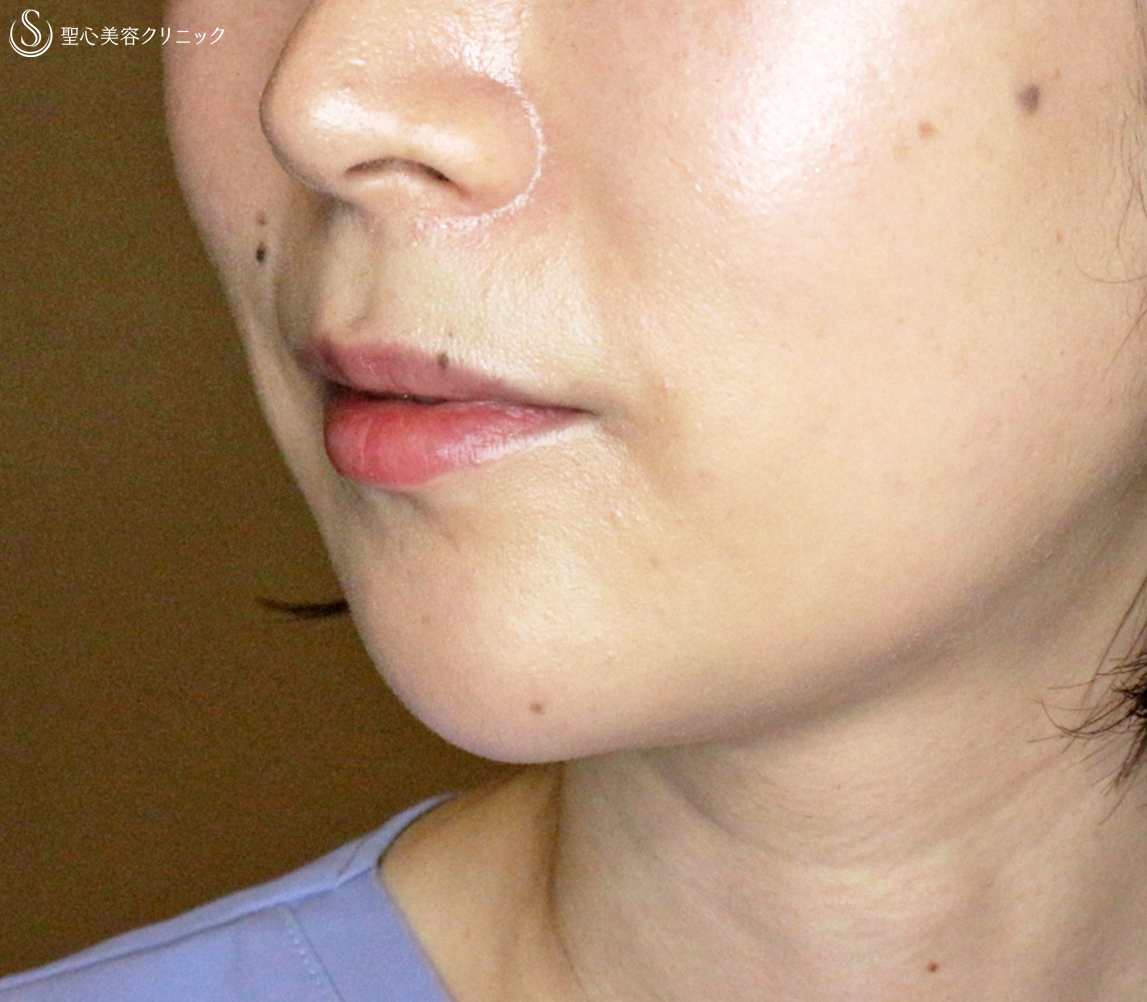 【30代女性・同時に小顔＆顔ヤセ効果】顎のヒアルロン酸注入（直後〜1週間後） After 