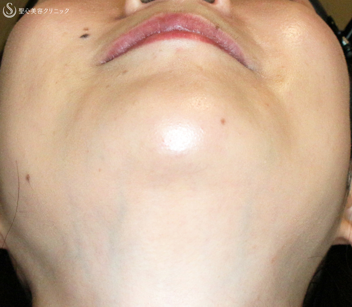 【30代女性・同時に小顔＆顔ヤセ効果】顎のヒアルロン酸注入（直後〜1週間後） After 