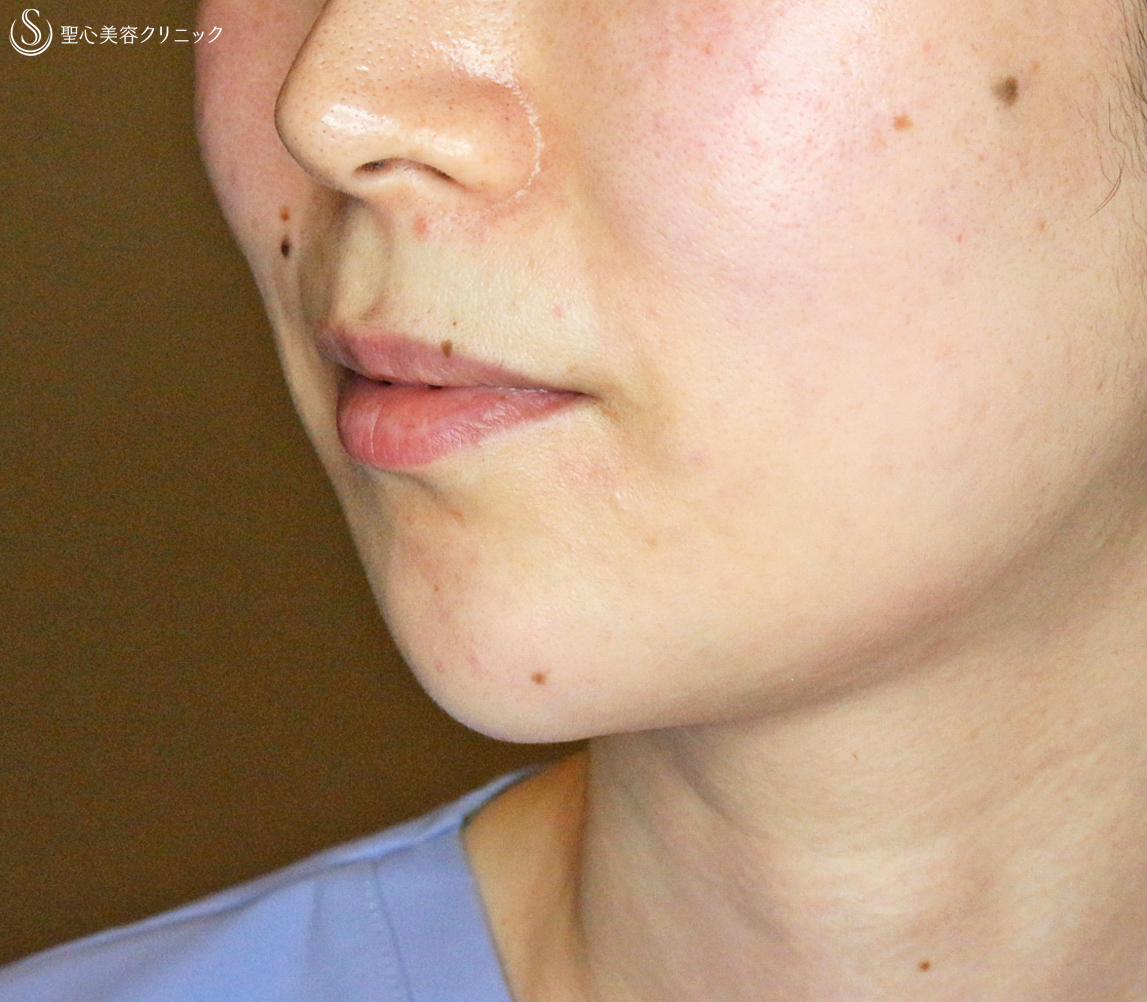 【30代女性・同時に小顔＆顔ヤセ効果】顎のヒアルロン酸注入（直後〜1週間後） Before 