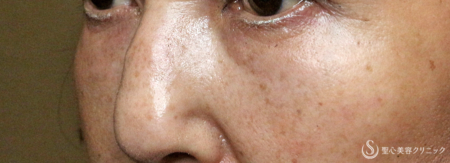 【50代女性・目の下のクマ・タルミを注入だけで驚きの効果】プレミアムPRP皮膚再生療法（6年後） After 