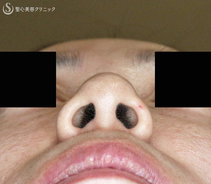 【40代女性・特徴的な小鼻】小鼻縮小術+α法（3年後） After 