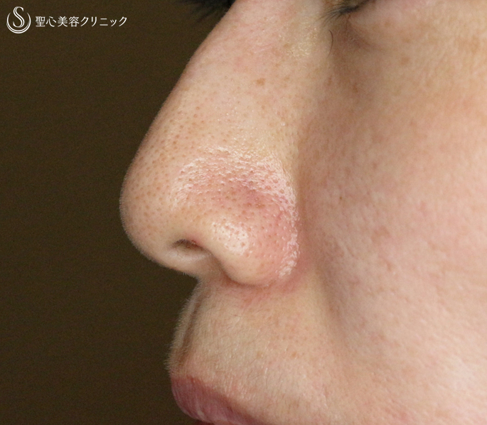 【40代女性・特徴的な小鼻】小鼻縮小術+α法（3年後） After 