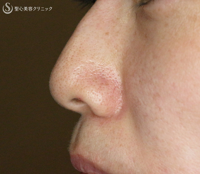 【40代女性・特徴的な小鼻】小鼻縮小術+α法（3年後） After 