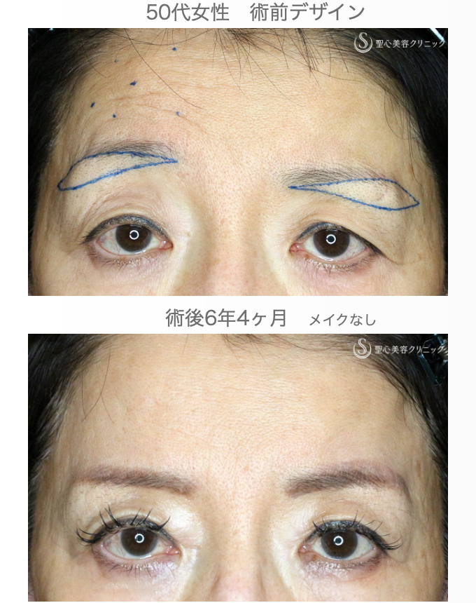 【50代女性・ベル麻痺+まぶたのたるみ】眉下リフト＆ボトックス（6年4ヶ月後） After 