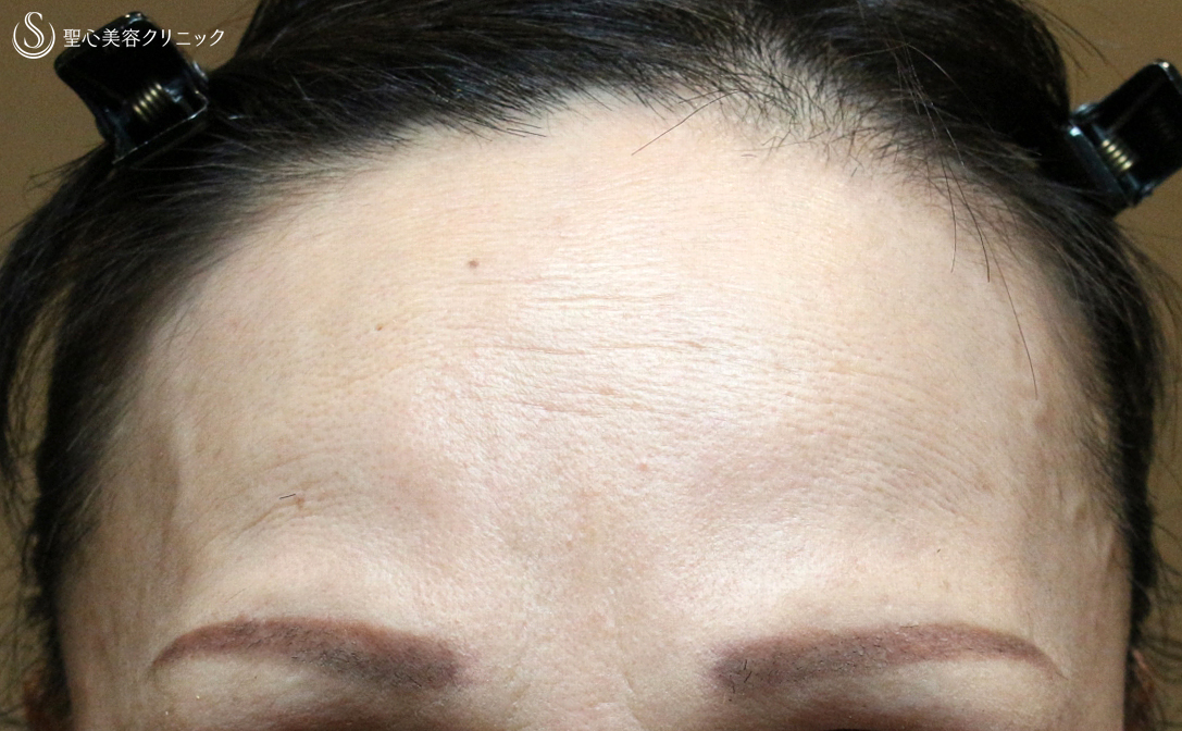 【50代女性・注入でオデコの若返り 】プレミアムPRP皮膚再生療法（4年後） Before 