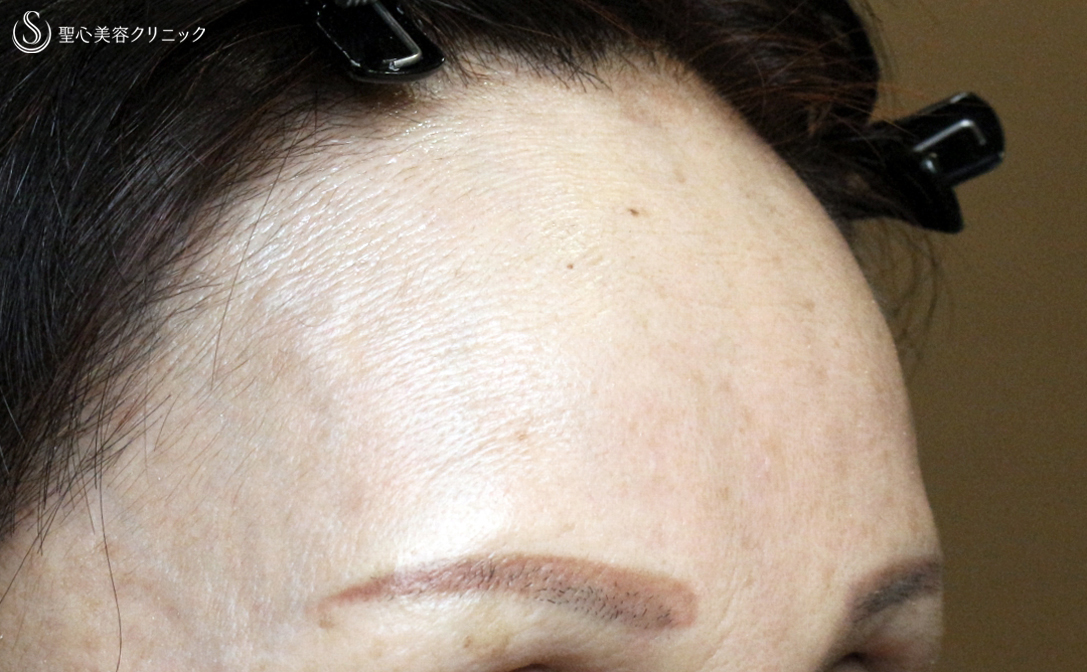 【50代女性・注入でオデコの若返り 】プレミアムPRP皮膚再生療法（4年後） After 