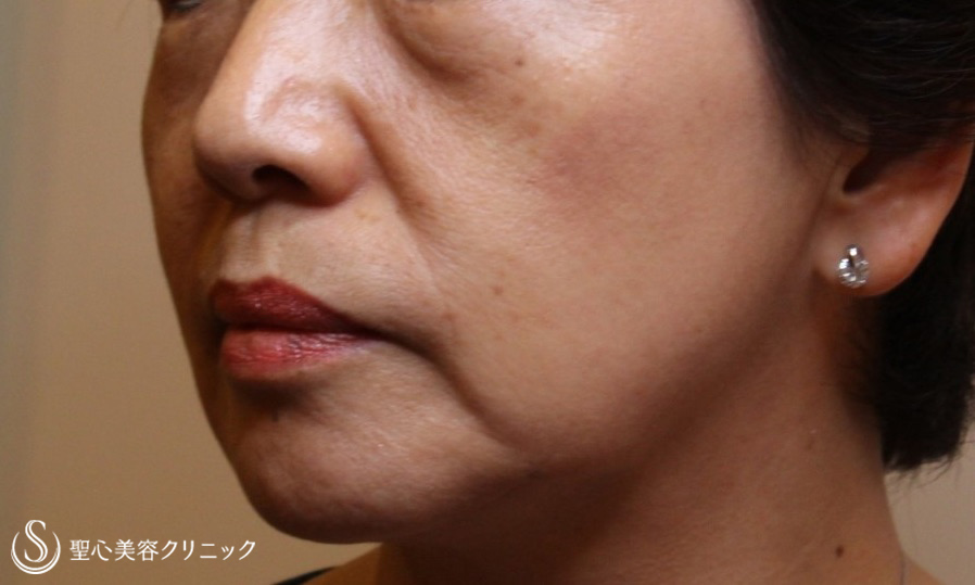 【60代女性・目の下や顔のたるみを長期的に改善】プレミアムPRP、ドクターハイフ（ウルセラシステム）2回後（9年後） Before 