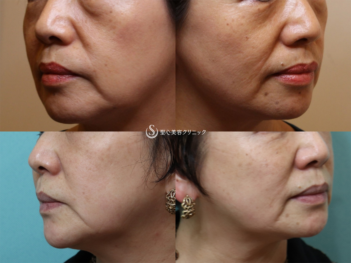【60代女性・目の下や顔のたるみを長期的に改善】プレミアムPRP、ドクターハイフ（ウルセラシステム）2回後（9年後） After 