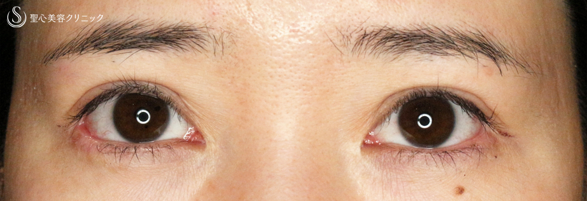 代女性 他院修正例 二重全切開 A法 目尻切開 グラマラスライン埋没法 4年2ヶ月後 症例写真 美容整形 美容外科なら聖心美容クリニック 代女性 他院修正例 二重全切開 A法 目尻切開 グラマラスライン埋没法 4年2ヶ月後 症例写真 美容整形 美容外科なら聖心美容クリニック