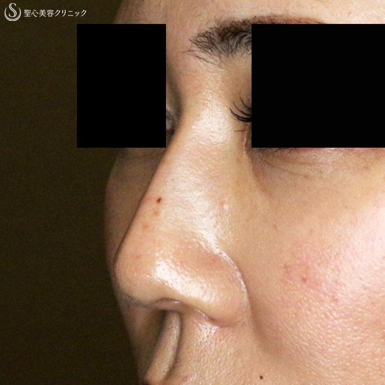 【40代女性・画期的な鼻のプチ整形】Gメッシュ単独（2年後） After 