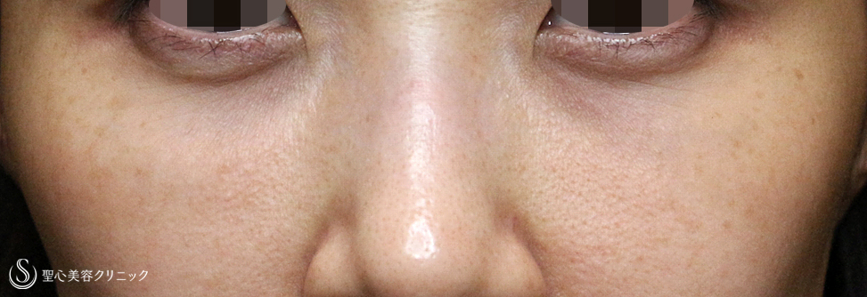 【30代女性・目の下のクマ長期経過】経結膜下脱脂術＆プレミアムPRP皮膚再生療法（5年6ヶ月後） After 