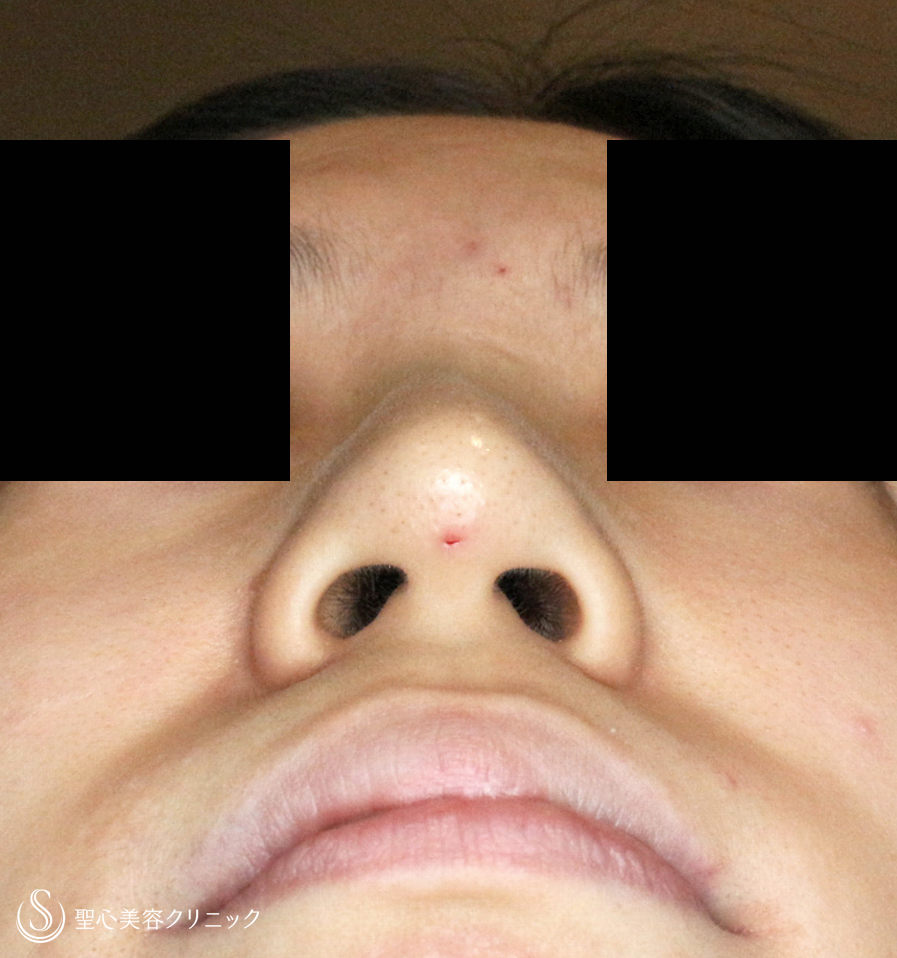【20代女性・満足度が高い鼻のプチ整形】Gメッシュ（4年後） Before 