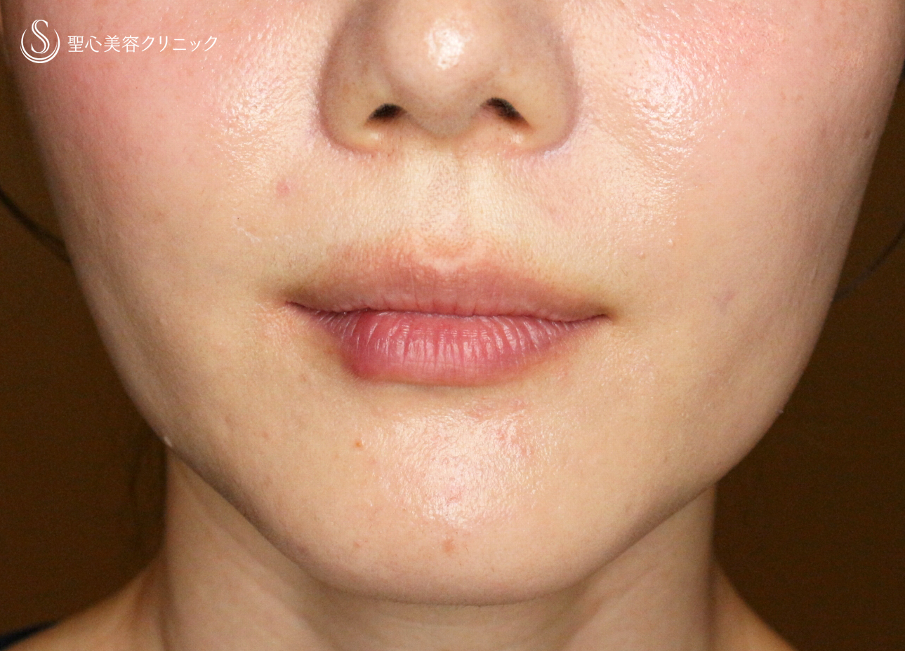 【30代女性・スマイルリップ注入法】ヒアルロン酸レスチレンリド（注入直後〜1ヶ月後） Before 