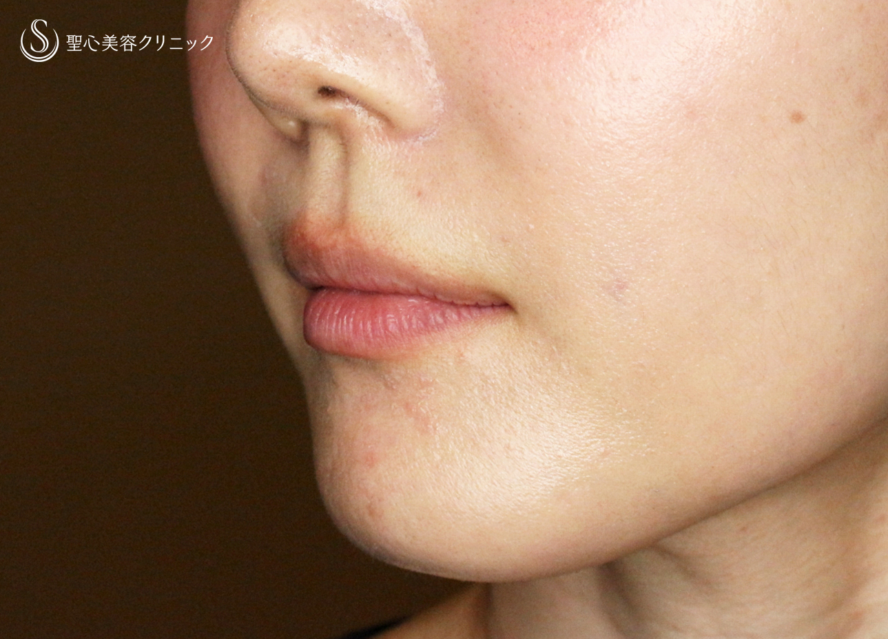 【30代女性・スマイルリップ注入法】ヒアルロン酸レスチレンリド（注入直後〜1ヶ月後） Before 