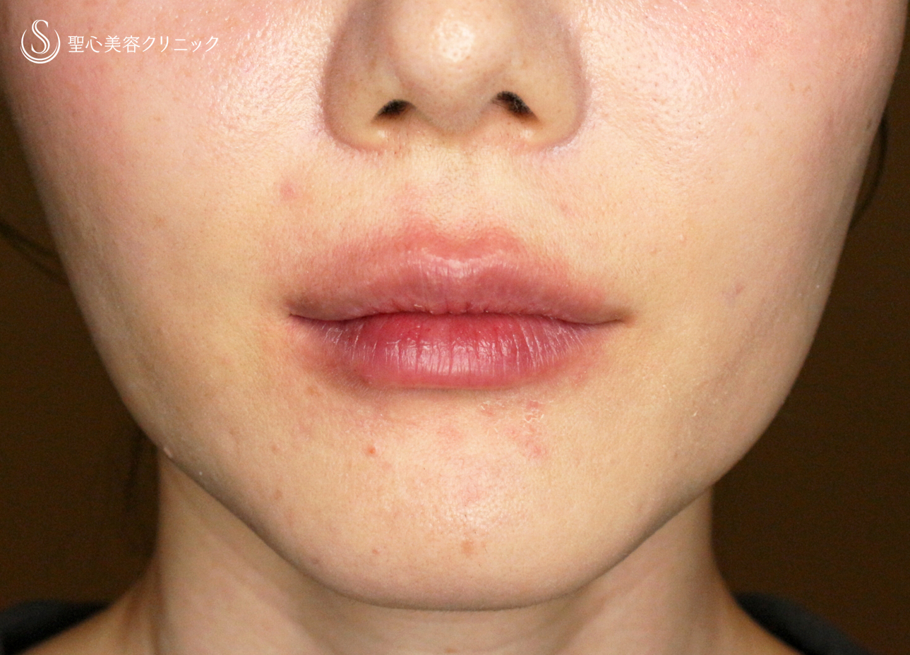 【30代女性・スマイルリップ注入法】ヒアルロン酸レスチレンリド（注入直後〜1ヶ月後） Before 