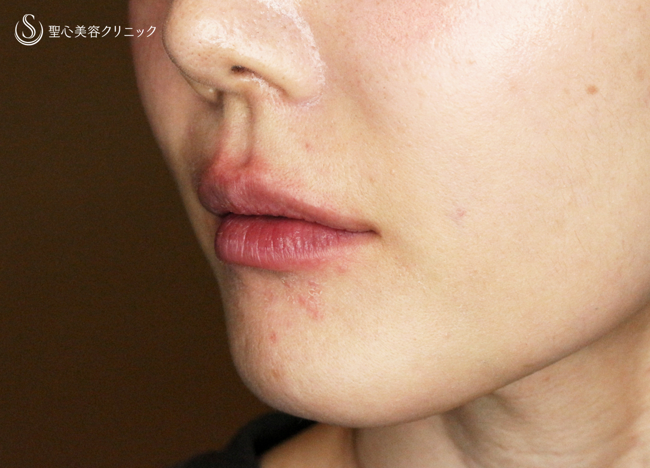 【30代女性・スマイルリップ注入法】ヒアルロン酸レスチレンリド（注入直後〜1ヶ月後） Before 