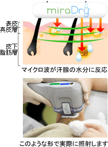 マイクロ波が汗腺の水分に反応　このような形で実際に照射します