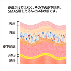 皮膚だけでなく、その下の皮下脂肪、SMAS層もたるんでいる状態です。