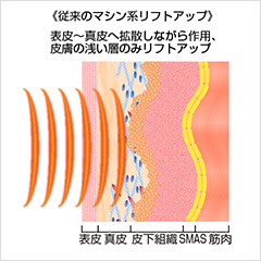 ＜従来のマシン系リフトアップ＞表皮～真皮へ拡散しながら作用、皮膚の浅い層のみリフトアップ