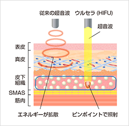 従来の超音波：エネルギーが拡散,ウルセラ（HIFU）：ピンポイントで照射