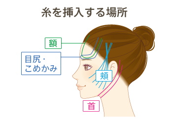 糸を挿入する場所：額・目尻・こめかみ・頬・首