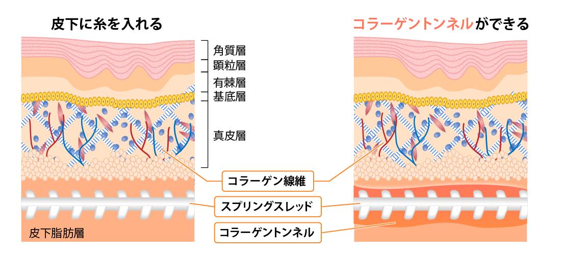 皮下に糸を入れる　コラーゲントンネルができる