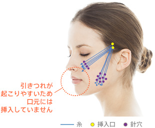 引きつれが起こりやすいため口元には挿入していません