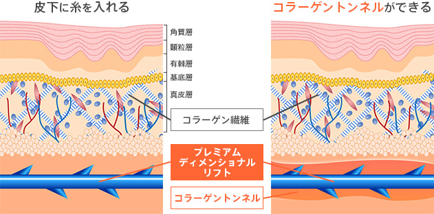 皮下に糸を入れる　コラーゲントンネルができる