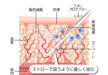 ストローで吸うように優しく吸引