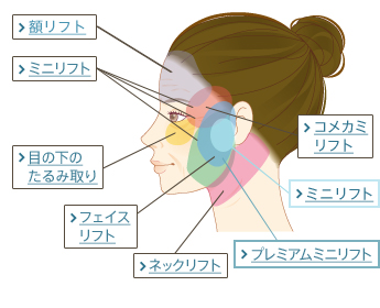 額リフト、ミニリフト、コメカミリフト、ミニリフト、目の下のたるみ取り、フェイスリフト、ネックリフト、プレミアムミニリフト