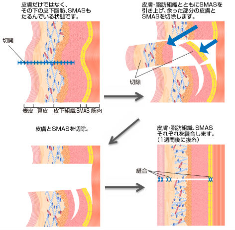 皮膚だけではなく、その下の皮下脂肪、SMASもたるんでいる状態です。→皮膚・脂肪組織とともにSMASを引き上げ、余った部分の皮膚とSMASを切除します。→皮膚とSMASを切除。→皮膚・脂肪組織、SMASそれぞれを縫合します。（1週間後に抜糸）
