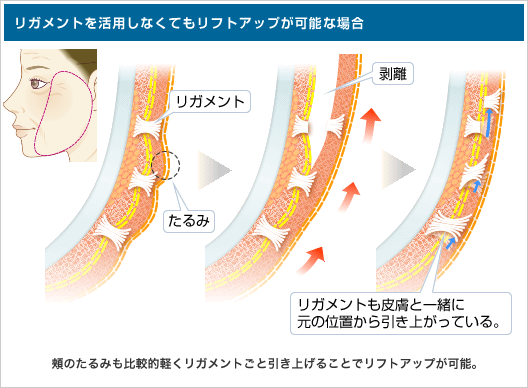 【リガメントを活用しなくてもリフトアップが可能な場合】リガメントも皮膚と一緒に元の位置から引きあがっている。頬のたるみも比較的軽くリガメントごと引き上げることでリフトアップが可能。