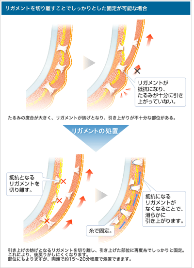 【リガメントを切り離すことでしっかりとした固定が可能な場合】リガメントが抵抗になり、たるみが十分に引き上がっていない。たるみの度合いが大きく、リガメントが妨げとなり、引き上がりが十分な部位がある。→リガメントの処置→抵抗となるリガメントを切り離す。糸で固定。抵抗になるリガメントがなくなることで、滑らかに引き上がります。引き上げの妨げとなるリガメントを切り離し、引き上げた部位に再度糸でしっかりと固定。これにより、後戻りがしにくくなります。部位にもよりますが、両頬で約15～20分程度で処置できます。